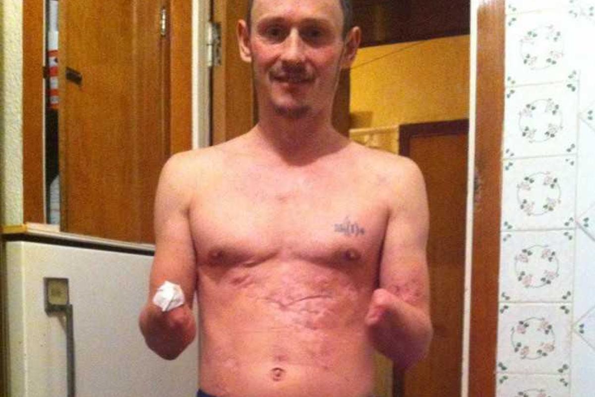 Для получения пенсии в "ДНР" от безрукого боевика требуют отпечатки пальцев