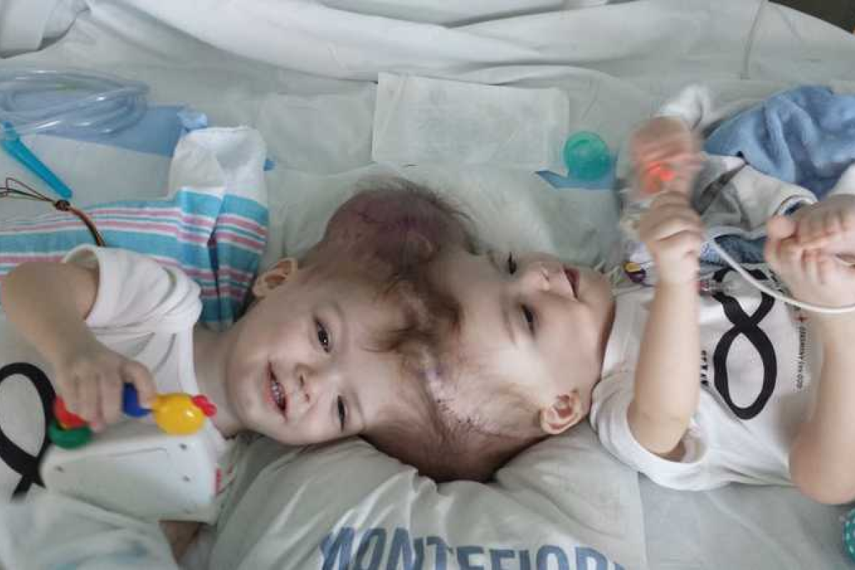 В США успешно разделили сиамских близнецов, которые срослись головами В США успешно разделили сиамских близнецов, которые срослись головами