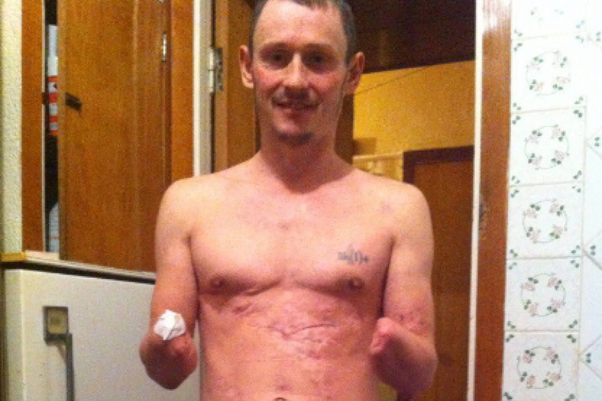 Нет рук - нет пенсии: как боевик-калека оказался в безвыходном положении Нет рук - нет пенсии: как боевик-калека оказался в безвыходном положении