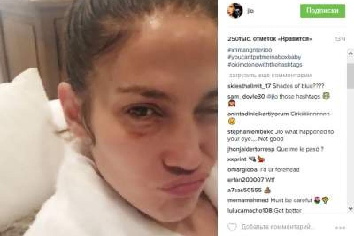 Джей Ло опубликовала снимок с фингалом под глазом