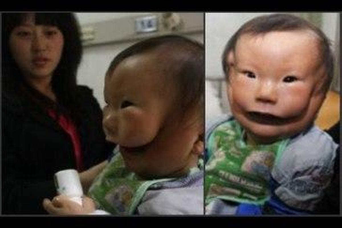 Сеть взбудоражил снимок мальчика с двумя лицами, живущего в Китае Сеть взбудоражил снимок мальчика с двумя лицами, живущего в Китае
