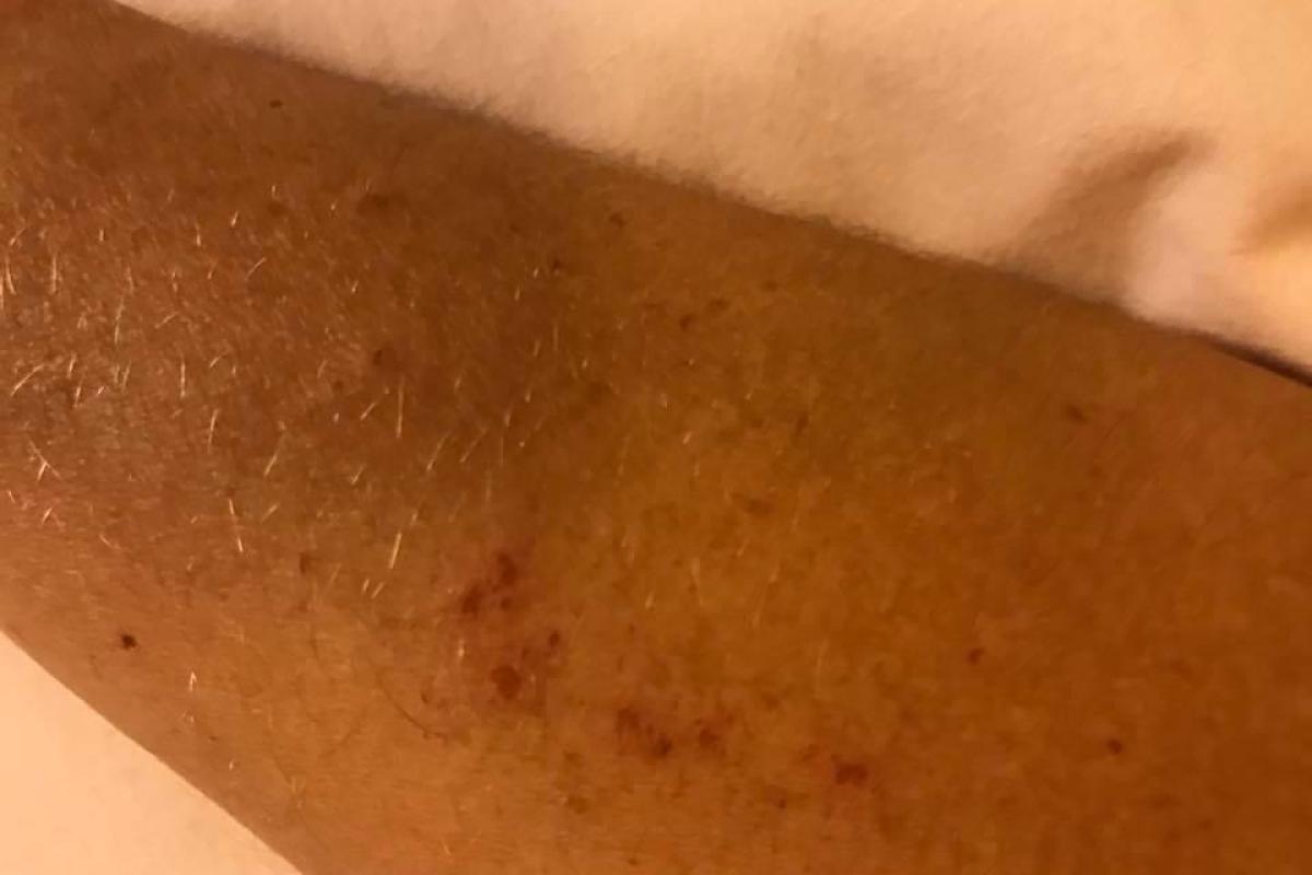 Псориаз после Минска: Геращенко показала, как ей даются переговоры по Донбассу Псориаз после Минска: Геращенко показала, как ей даются переговоры по Донбассу