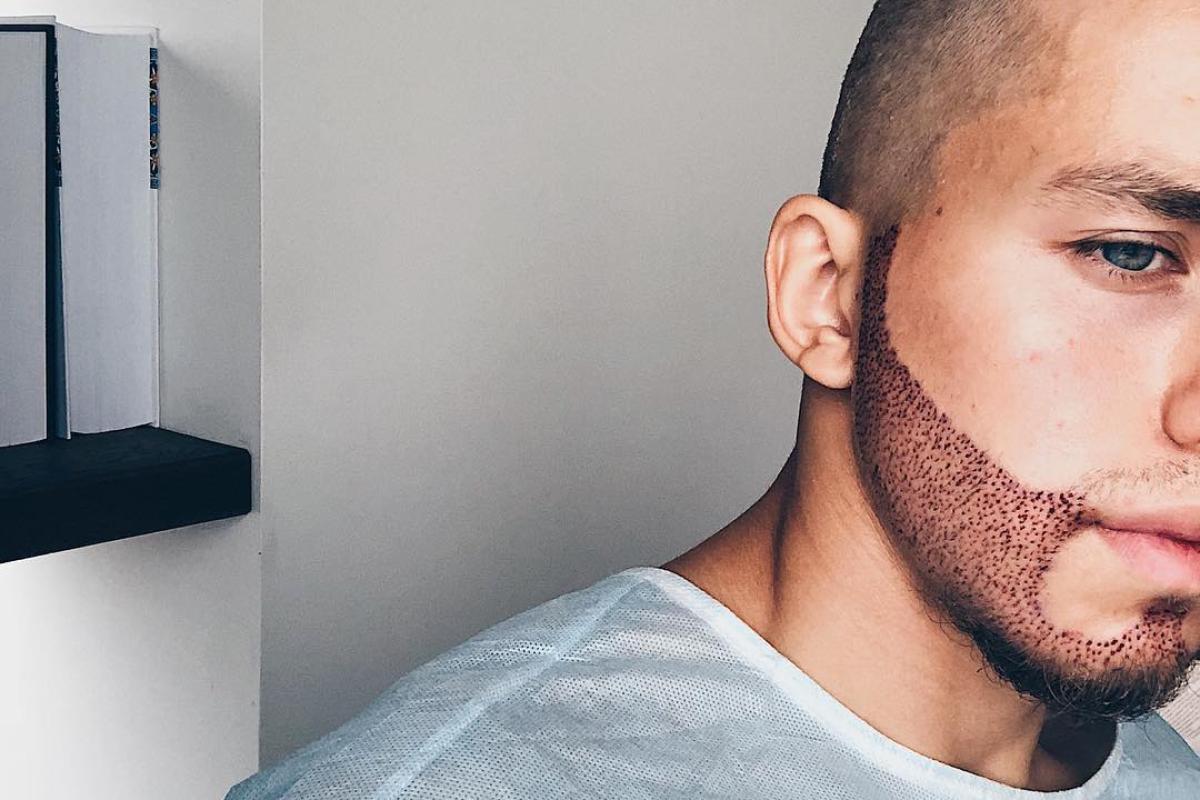 Исполнил давнюю мечту: Звезда сериала «Ольга» пересадил волосы с затылка на лицо