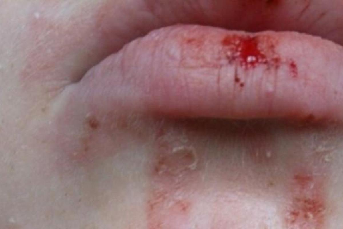 В России школьнице плеснули в лицо кислотой: девочка просто шла домой В России школьнице плеснули в лицо кислотой: девочка просто шла домой