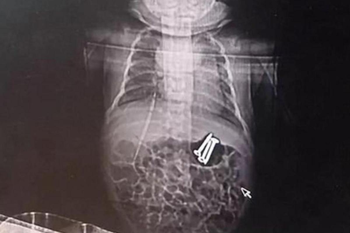 Трехлетний китаец накормил новорожденного брата гвоздями Трехлетний китаец накормил новорожденного брата гвоздями