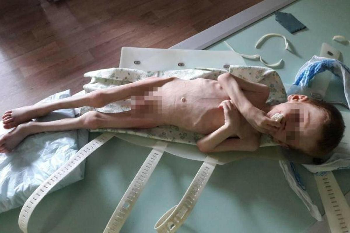 Весит всего 7 килограмм: В Кировоградской области родители морили голодом 4-летнего ребенка Весит всего 7 килограмм: В Кировоградской области родители морили голодом 4-летнего ребенка