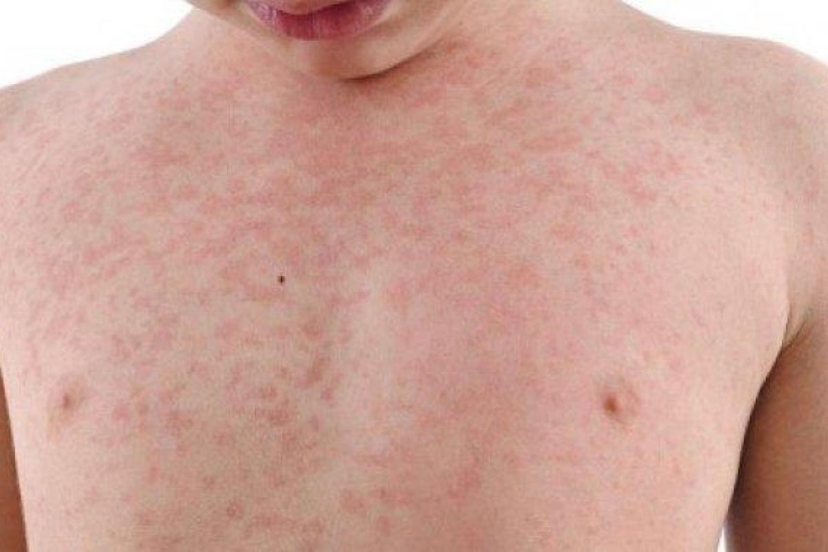 В Украине могут объявить эпидемию кори