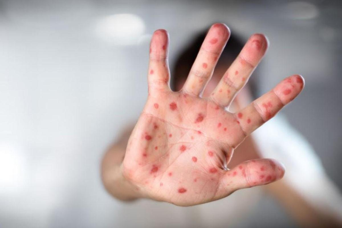 "57 случаев кори за неделю!": На Донетчине за последние сутки еще 14 заболевших