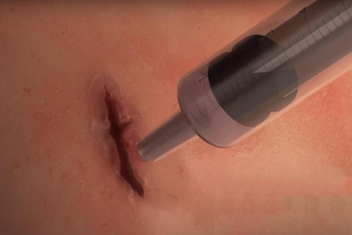 В Австралии изобретен клей, способный стянуть рану за 60 секунд В Австралии изобретен клей, способный стянуть рану за 60 секунд