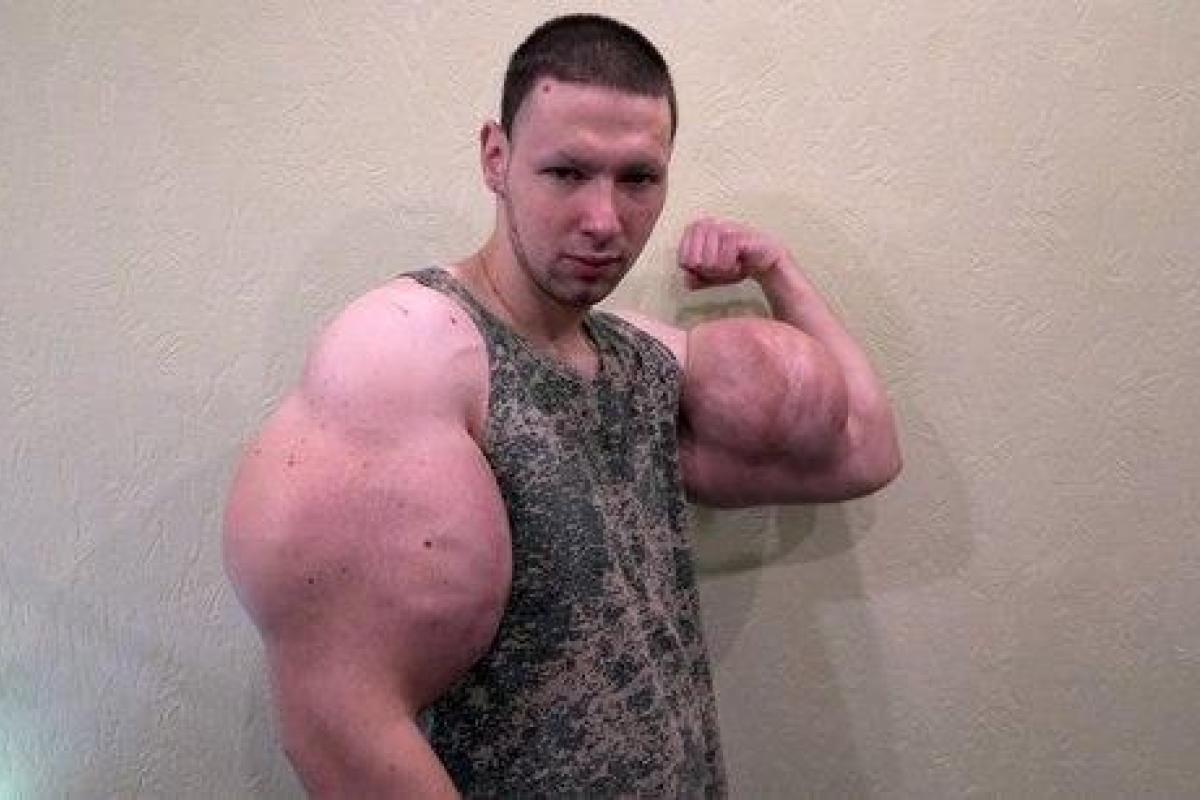 Врачи удалили "руки-базуки" блогеру Кириллу Терешину Врачи удалили "руки-базуки" блогеру Кириллу Терешину