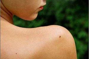 Медики: Родинки могут быть предвестником рака молочной железы