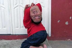 Мужчина, родившийся с перевернутой головой, выжил несмотря на прогнозы врачей