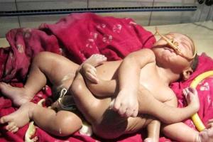 В индийском городе Баруйпур родился младенец с восемью конечностями