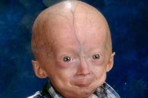 Самые странные болезни мира, которые пока остаются загадкой для человечества