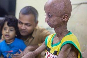 В Индии живет подросток, похожий на инопланетянина