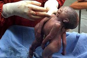 В Индии на свет появились сиамские близнецы с одной головой