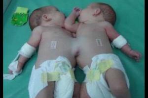 В Москве продолжается операция по разделению девочек-сиамских близнецов