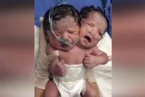 В Мексике на свет появился двухголовый младенец