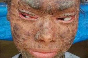 В Индии живет "девочка-змея", страдающая редким генетическим заболеванием