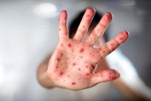 В Лисичанске зарегистрирована вспышка кори