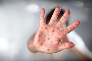 В Украине с начала года корью заболели более 53 тысяч украинцев, от осложнений умерли 18