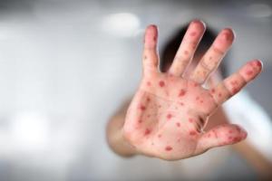 В Украине зафиксирована вспышка кори