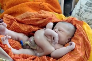 В Індії на світ з'явилася незвичайна дитина: у немовляти 4 руки і 4 ноги
