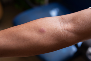 проба Манту