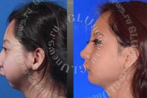 В Японии пластические хирурги помогли лишенной челюсти девушке