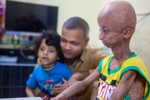 В Индии живет мальчик с синдромом Бенджамина Баттона