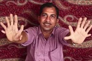 В Индии живет мужчина у которого 28 пальцев