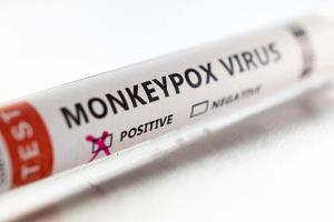 У Грузії виявили перший випадок зараження віспою мавп