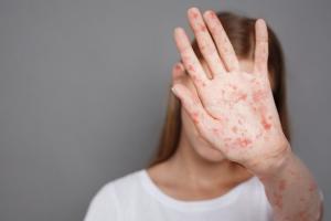 Оккупанты скрывают информацию о вспышке кори в Бердянске