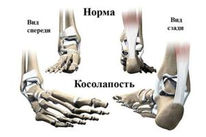 Ортопедические заболевания стоп у детей и их профилактика