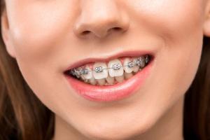 встановлення брекетів у FrankoLab Clinic