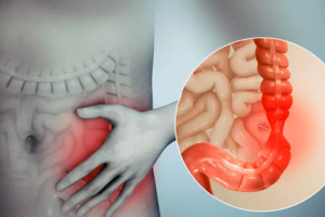 Синдром подразненого кишківника