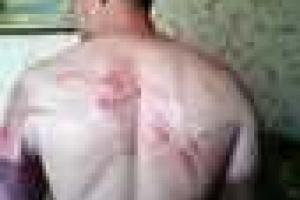 Пастор, побывавший в плену у боевиков "ДНР", показал, что они с ним сделали 