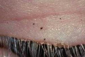 У китаянки из глаза вытащили 20 вшей