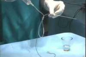 Россиянка прожила три года с медицинским зажимом в животе