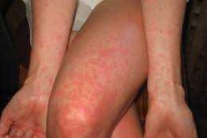 Киевлянка с лихорадкой Денге идет на поправку 