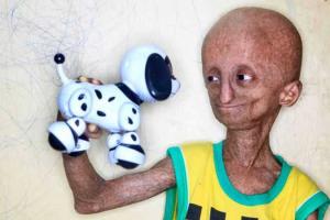 14-летний подросток из-за редкого заболевания похож на пришельца (18+)