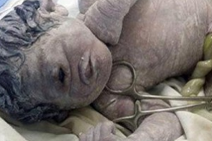 В Египте на свет появился мальчик-циклоп