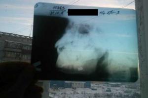 Россиянин выстрелил в лицо 11-летнему мальчику