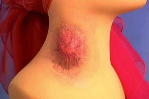 В Крыму впервые за 20 лет зарегистрирован случай опасного заболевания