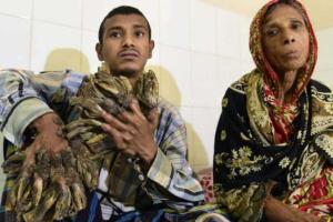 Из-за редкого заболевания тело жителя Бангладеша покрылось "древесной корой"