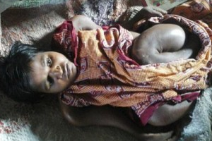 25-летняя девушка из-за болезни уменьшилась до размеров младенца