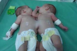 В Росии родились сиамские близнецы, которые срослись печенью