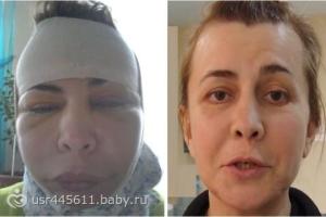 Звезды шоу "Дом-2", которые делали пластику