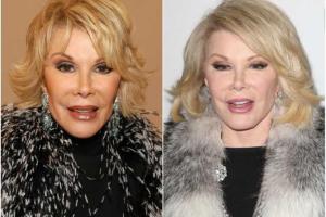 Десять знаменитостей, которые перестарались с "уколами красоты"