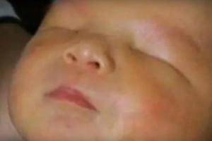 В Китае родился мальчик без глаз